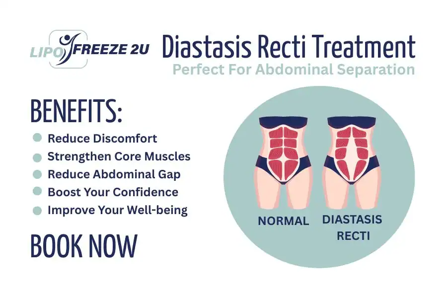 How Long Will It Take to See Improvements in Diastasis Recti Christchurch
