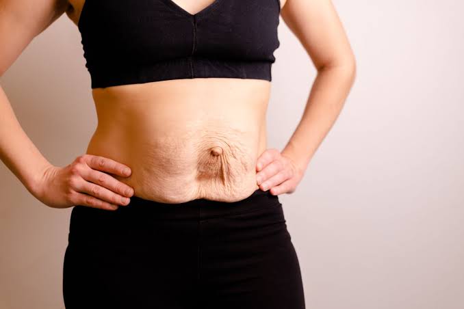 Is Surgery Really the Only Way to Repair Diastasis Recti Christchurch?