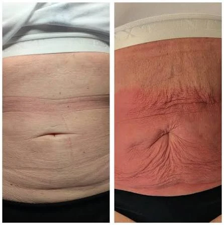 How Does RF Microneedling Improve Crepey, Thin and Uneven Skin Texture Christchurch?