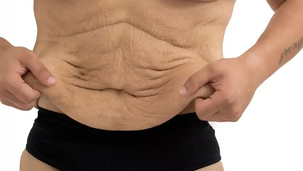 RF Microneedling for Loose Skin: How Can It Help Tighten and Reshape the Skin Christchurch?